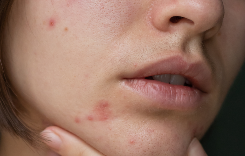Acne guide